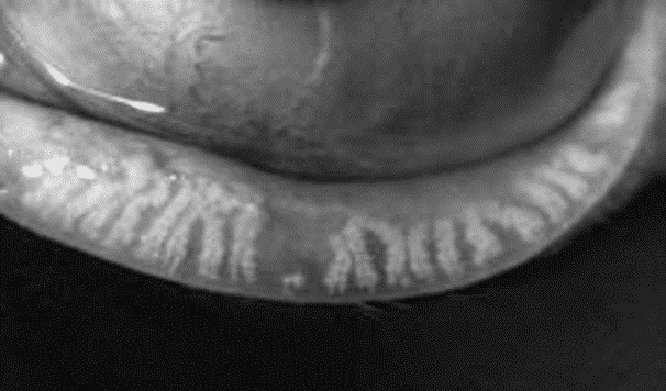 Eyelid Gland